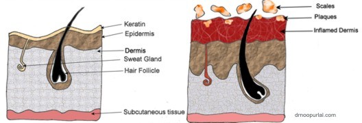 Healthy skin and Psoriasis